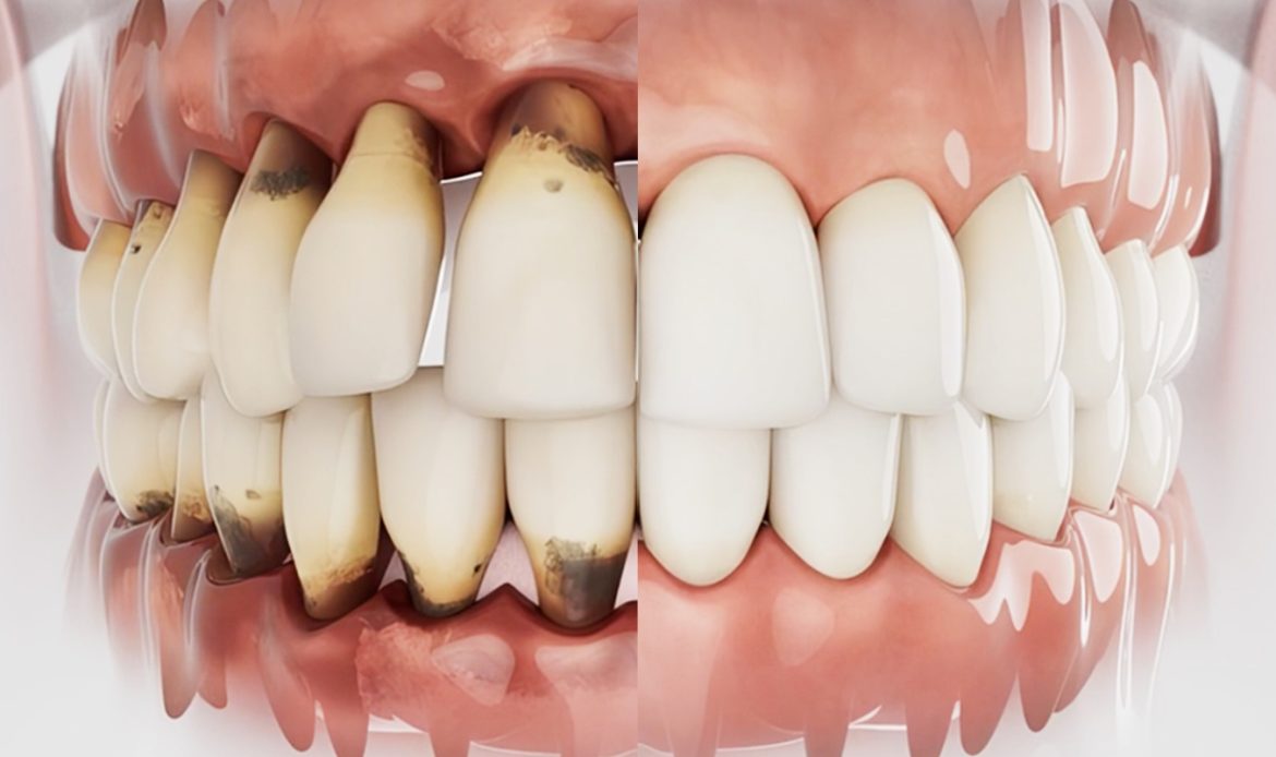 dental implants