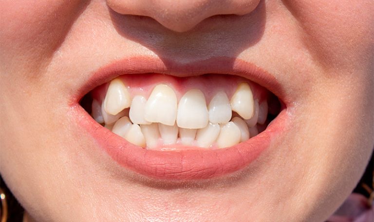 What is tooth mobility?.