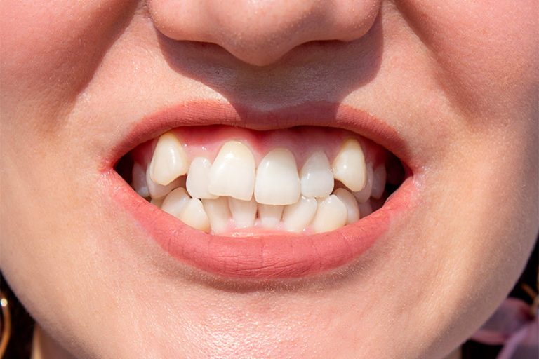 What is tooth mobility?.