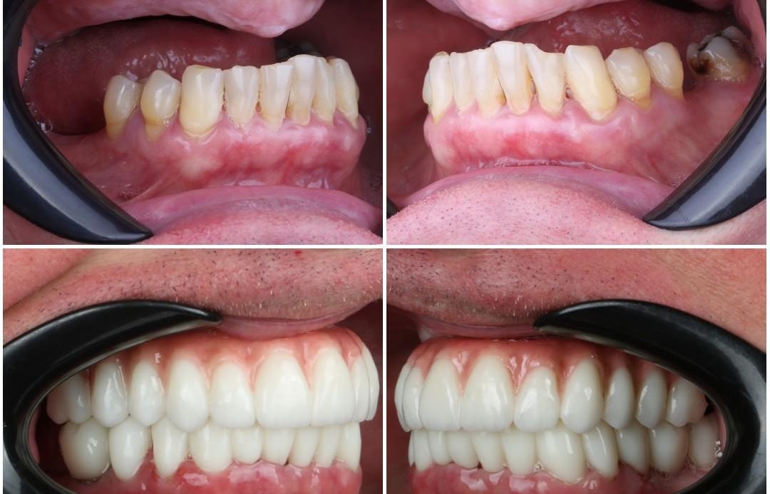 cancun dental implants