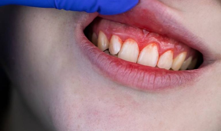 Treating Bleeding Gums
