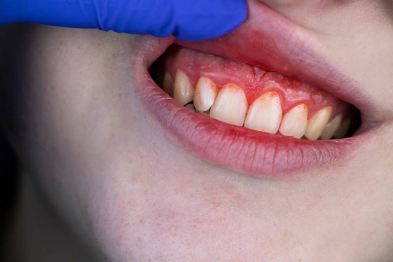 Treating Bleeding Gums