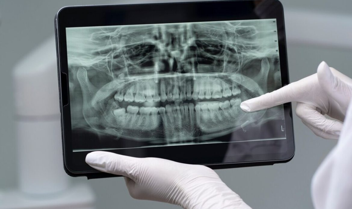 dental bone grafts procedures