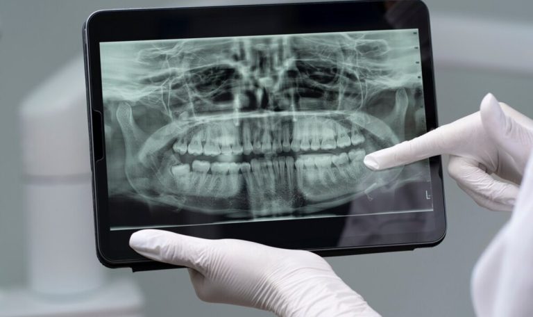 dental bone grafts procedures