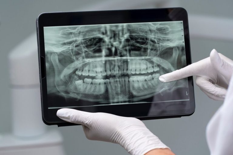 procedimientos de injertos óseos dentales