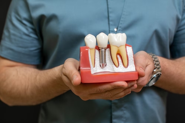 What is a Dental Graft