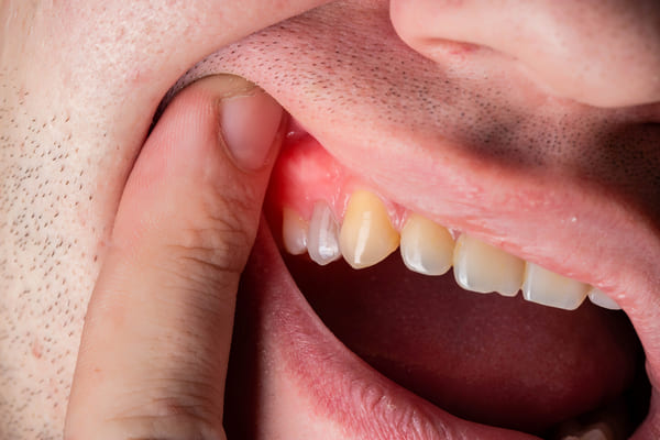 absceso dental
