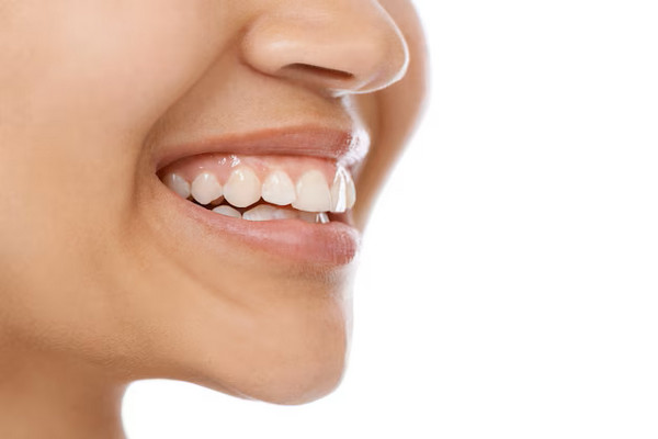Qué es una sonrisa gingival