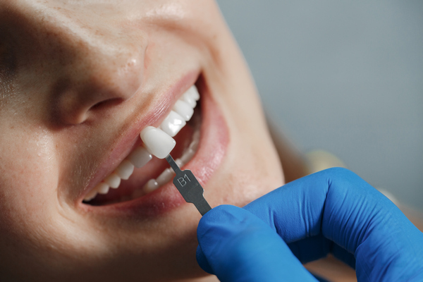 Cuándo hay que sustituir una corona dental