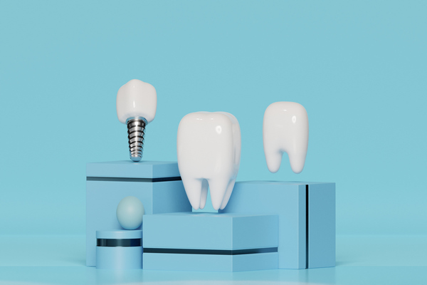 Dentaduras vs. Implantes dentales