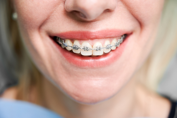 Por qué se colocan los brackets antes de las carillas dentales