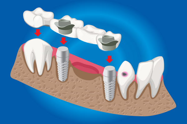Puentes dentales