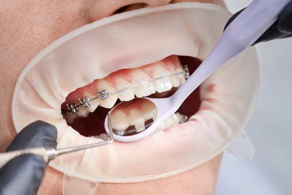 The Advantages of Braces Before Veneers