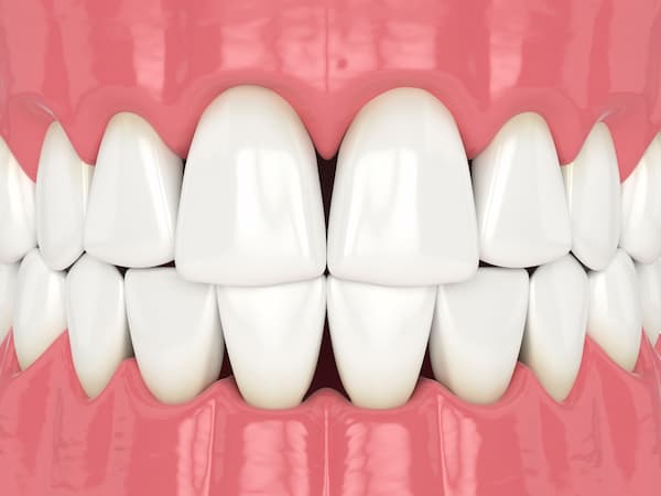 Black Triangle Treatment