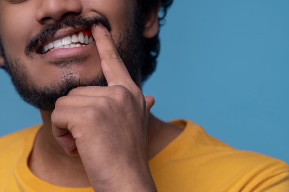 La periodontitis como causa de triángulos negros
