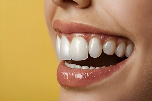 Tratamientos para la Sensibilidad Dental Después de las Carillas