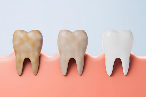 Brown Spots and Stains on Teeth