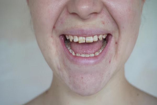 Brown Spots on teeth