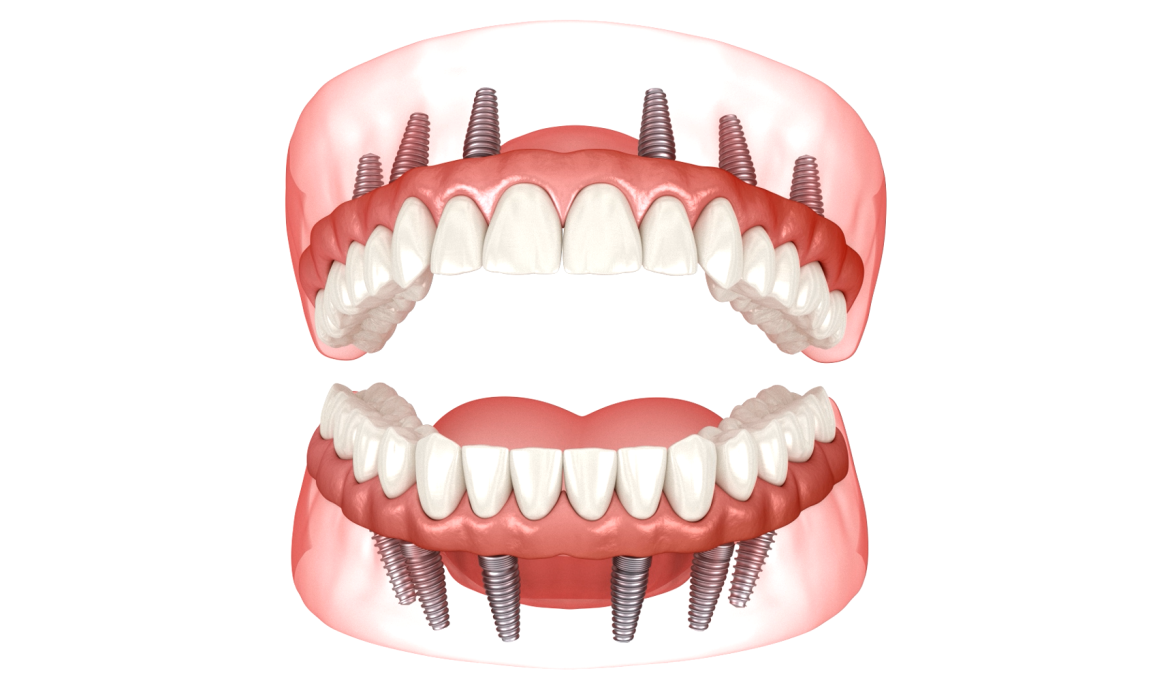 All-on-6 full-arch dental implant technique illustration, Shtern Dental Clinic Cancun