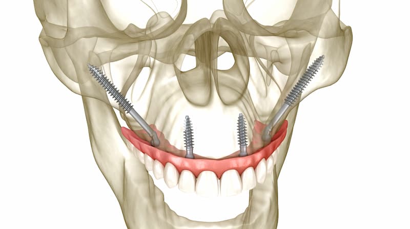 Zygomatic dental implant technique illustration, Shtern Dental Clinic Cancun