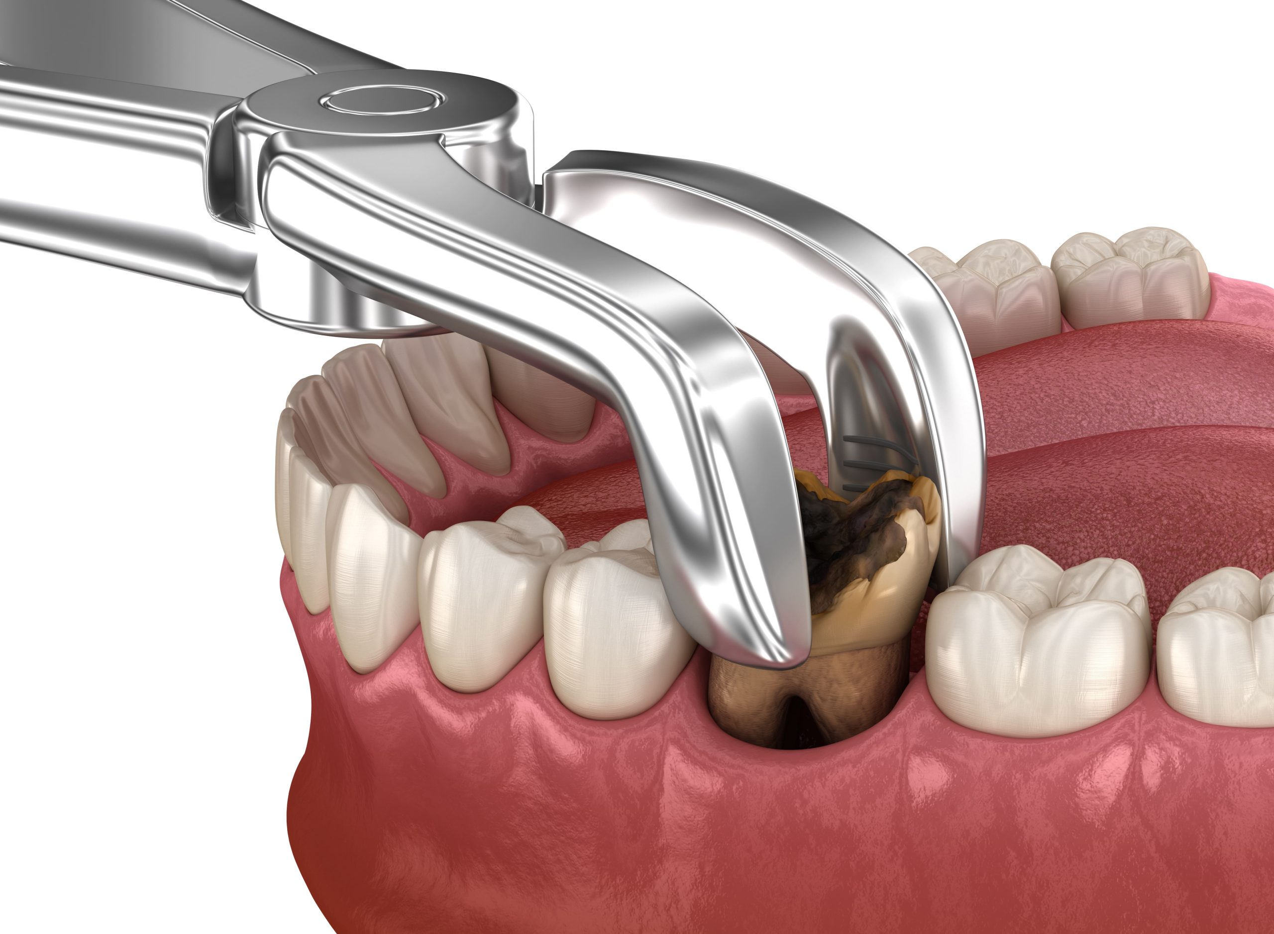Surgical tooth extraction at Shtern Dental Clinic in Cancun
