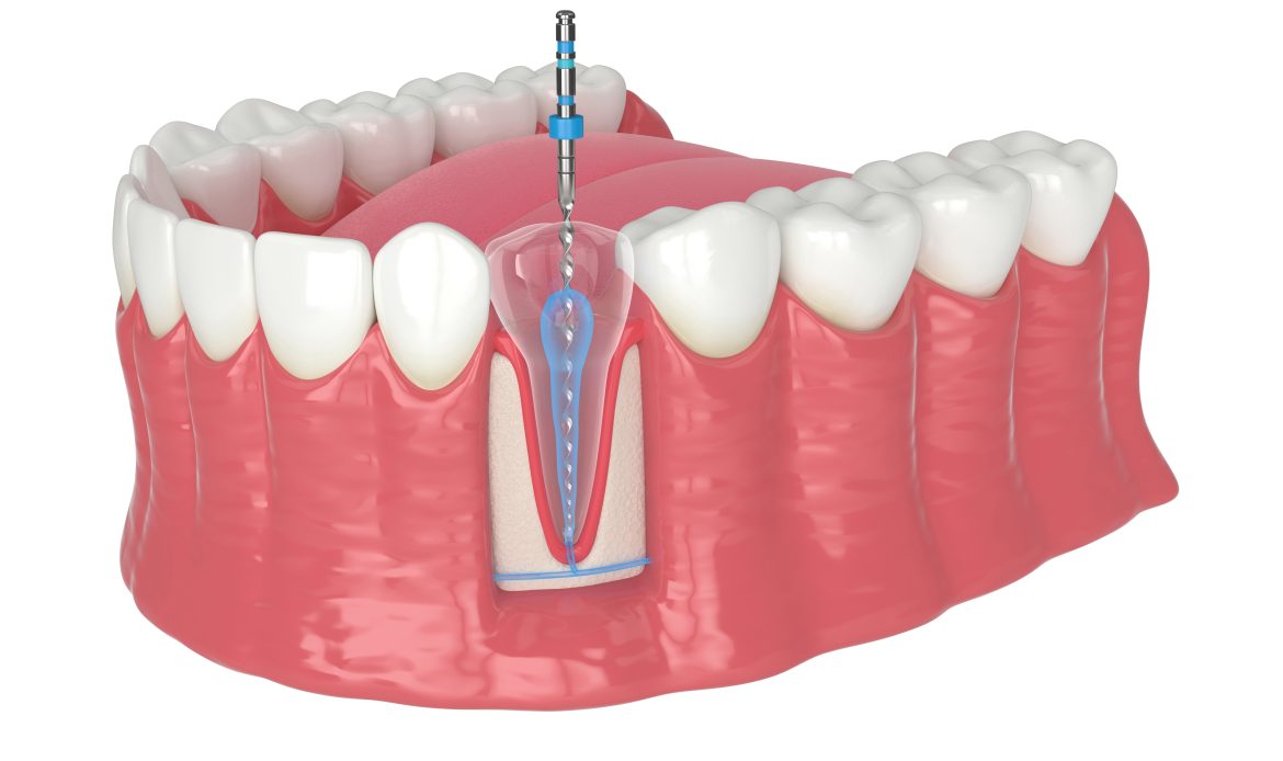 Root canal treatment at Shtern Dental Clinic in Cancun
