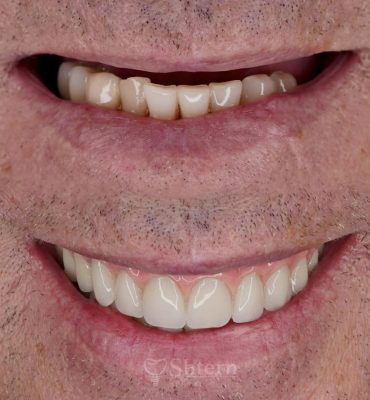 all on 4 dental implants