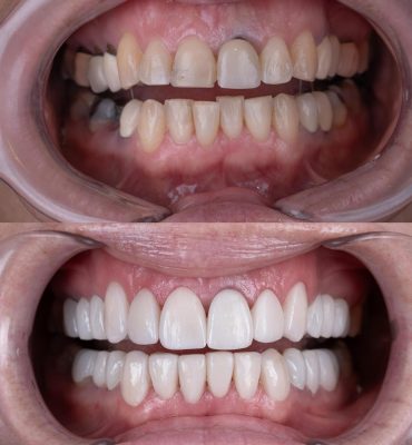 dental crowns cancun mexico