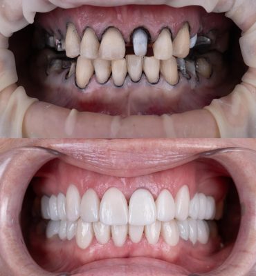 dental crowns cancun