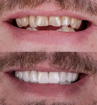 dental crowns in cancun