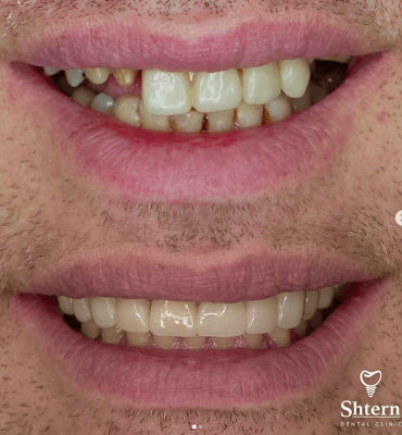 dental implants in mexico