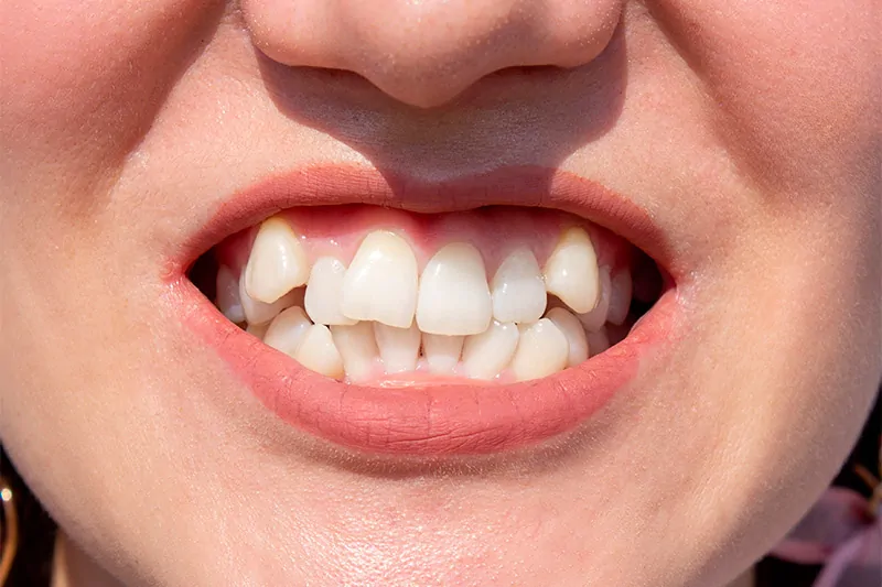 What is tooth mobility?.