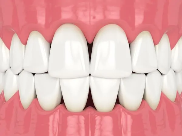 Black Triangle Treatment