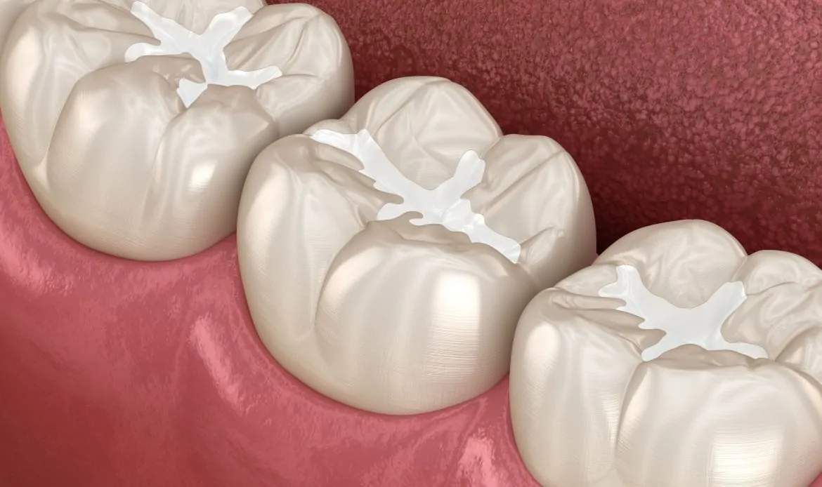 Composite fillings at Shtern Dental Clinic in Cancun