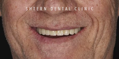 Before-and-after comparison of dental implants, patient case at Shtern Dental Clinic Cancun
