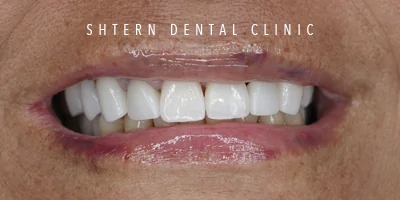 Before-and-after comparison of dental implants, patient case 2, Shtern Dental Clinic Cancun