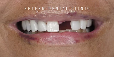 after dental implants, patient case at Shtern Dental Clinic Cancun