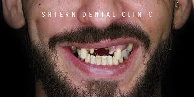 Before dental implants, patient case at Shtern Clinic Cancun