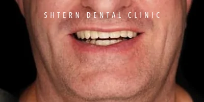 comparison after dental implants, patient case 7, Shtern Dental Clinic Cancun