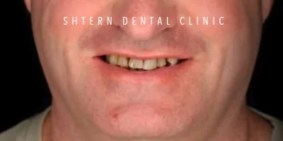 Before-and-after comparison of dental implants, patient case 7, Shtern Dental Clinic Cancun