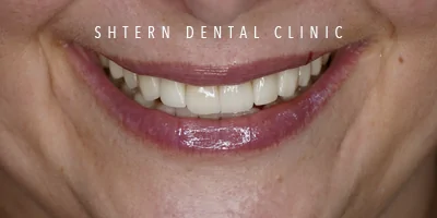 after dental implants, patient case at Shtern Dental Clinic Cancun