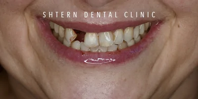 Before-and-after comparison of dental implants, patient case, Shtern Dental Clinic Cancun