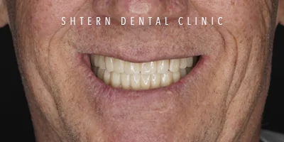 Before-and-after comparison of dental implants, patient case at Dental Clinic Cancun